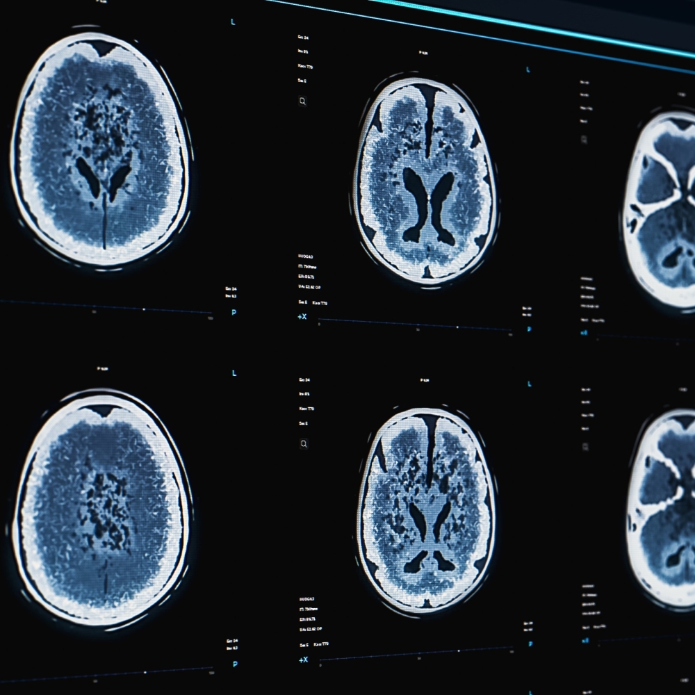Sharper, Faster, Smarter: Quantum Sensing in Healthcare